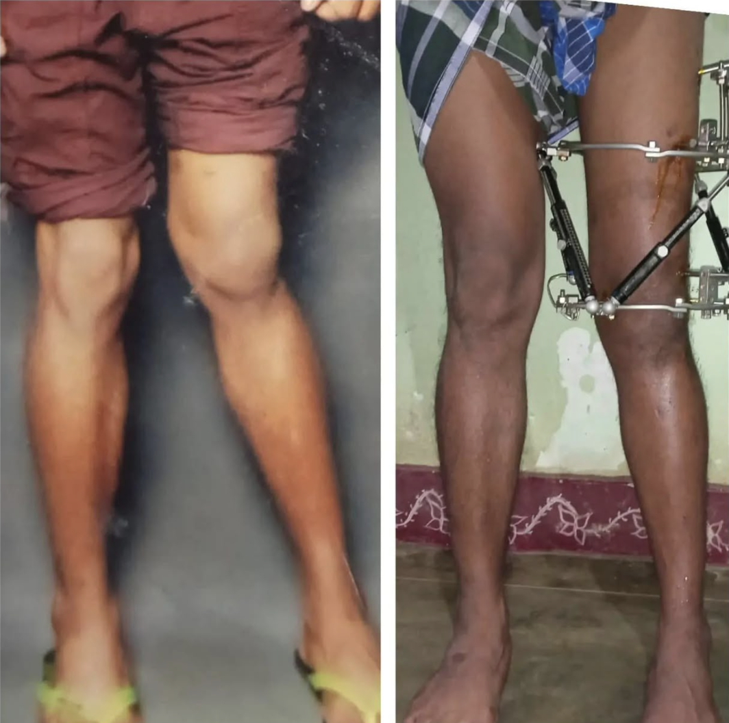 Deformity correction and limb lengthening using hexapod frame for knock knees