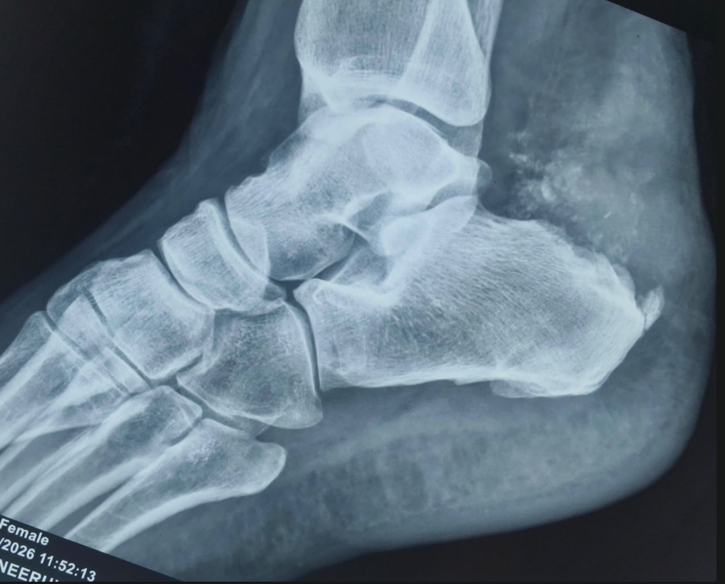 Post-operative X-ray after Haglund's deformity bursectomy and calcaneal reshaping showing smooth heel contour