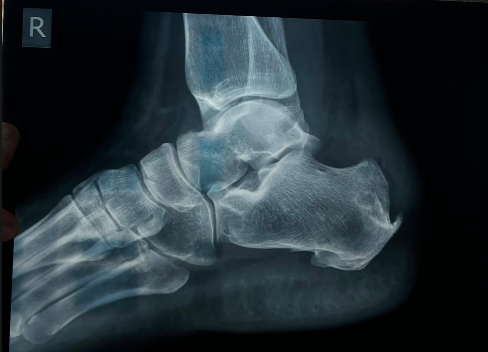Pre-operative X-ray showing Haglund's deformity with prominent bony spur at posterior calcaneus