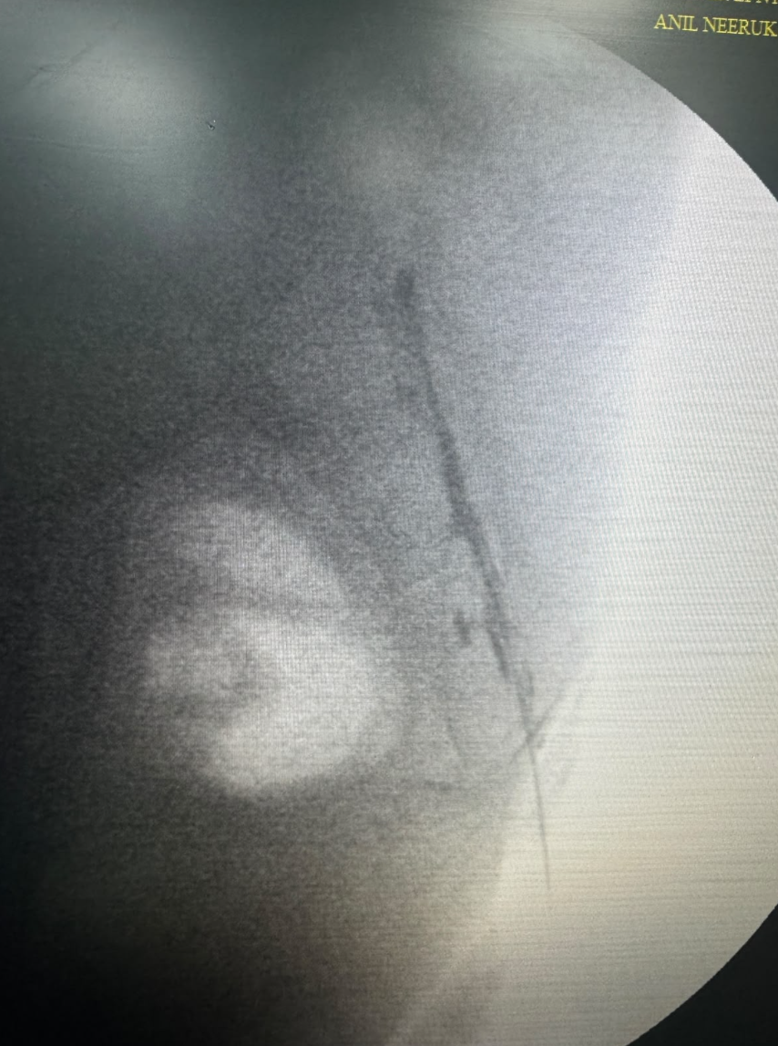 Caudal epidural steroid injection for disc prolapse and lumbar degeneration
