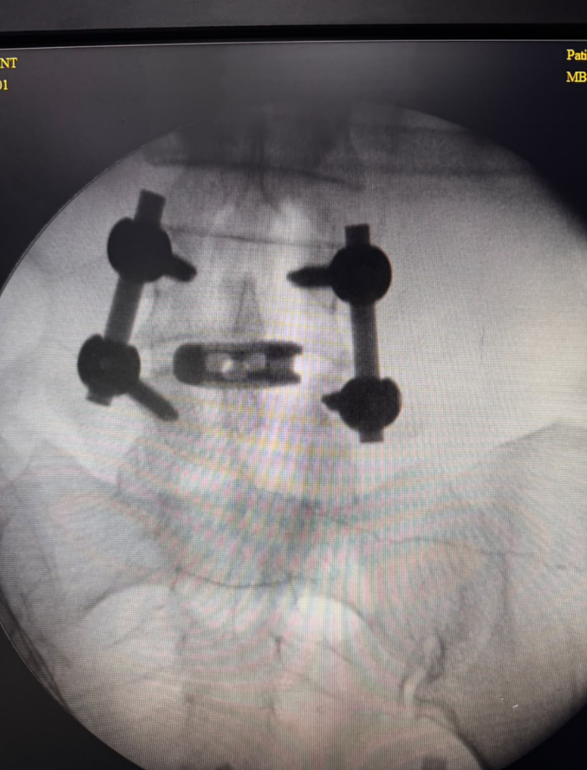 Spine fixation and fusion X-ray showing hardware placement