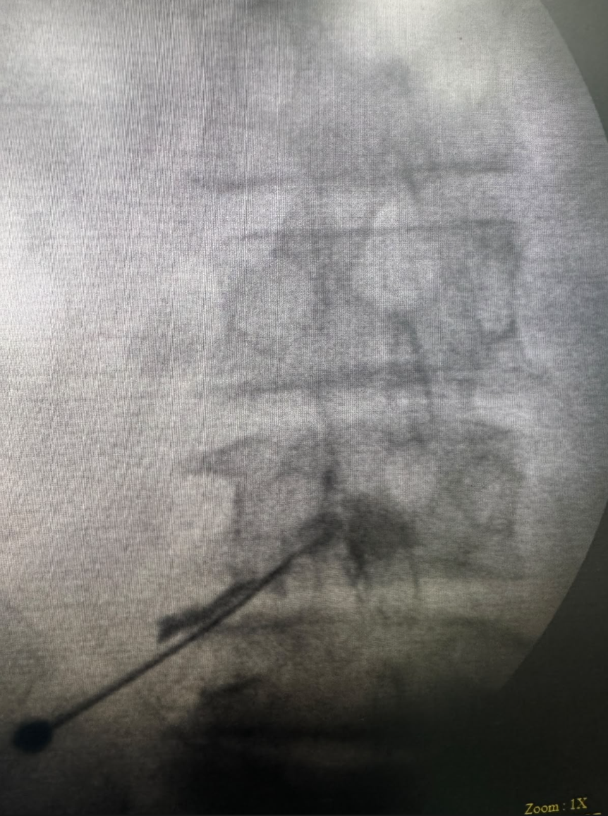 Spine pain management procedure - Transforaminal Epidural Steroid Injection