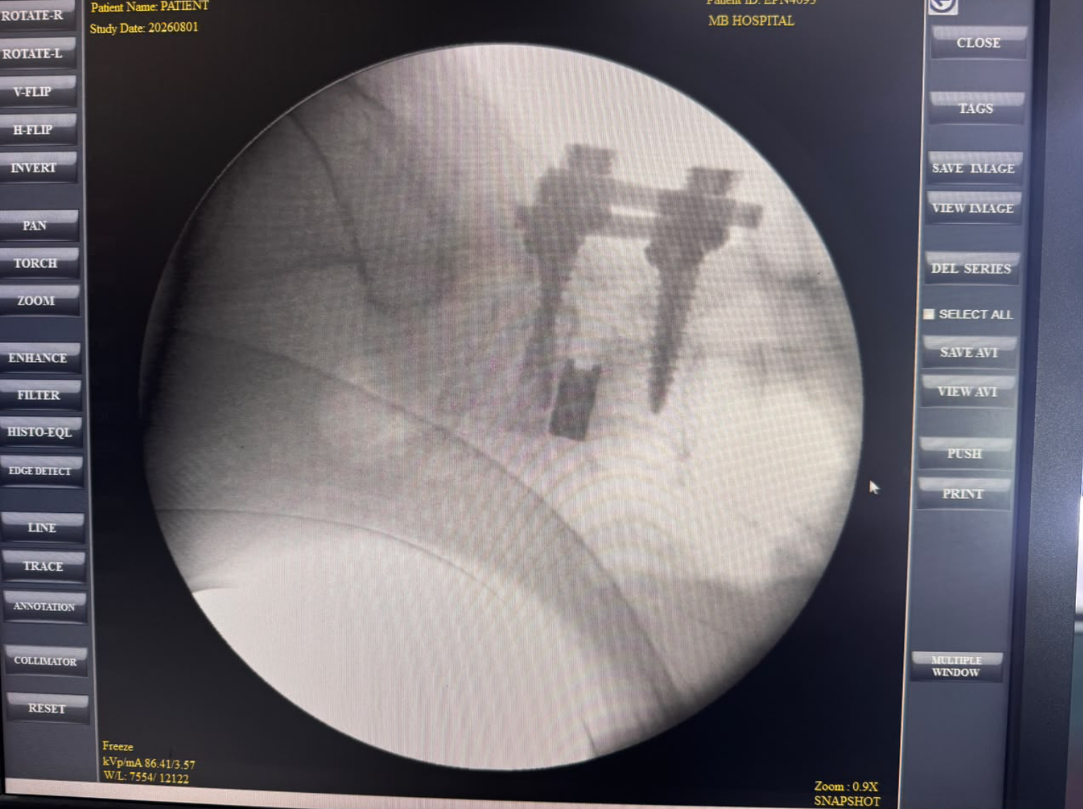 TLIF spine fixation and fusion post-operative X-ray