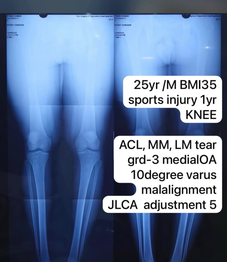 X-ray showing ACL tear, medial meniscus injury and varus malalignment