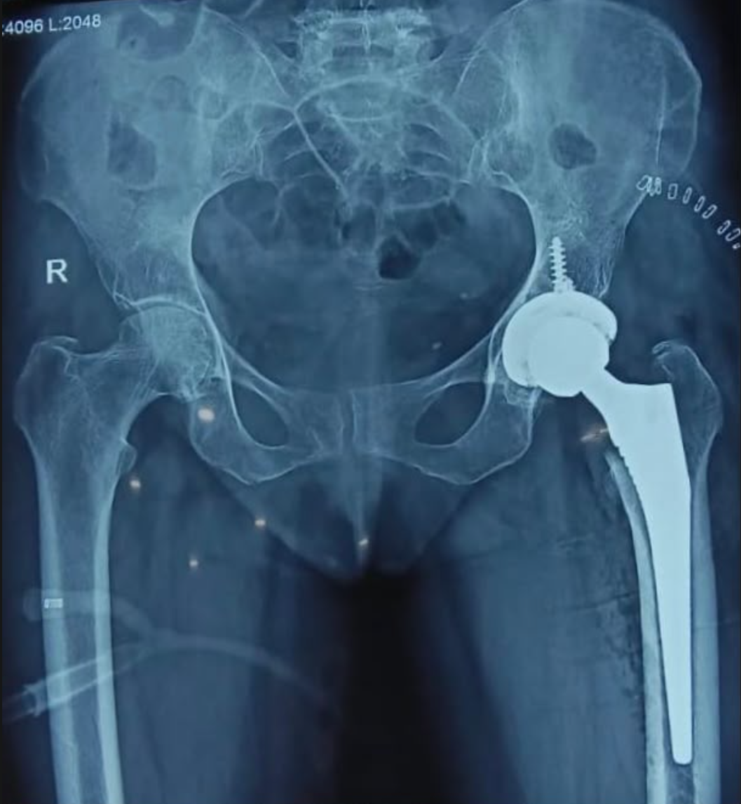 Post-operative X-ray showing total hip replacement prosthesis