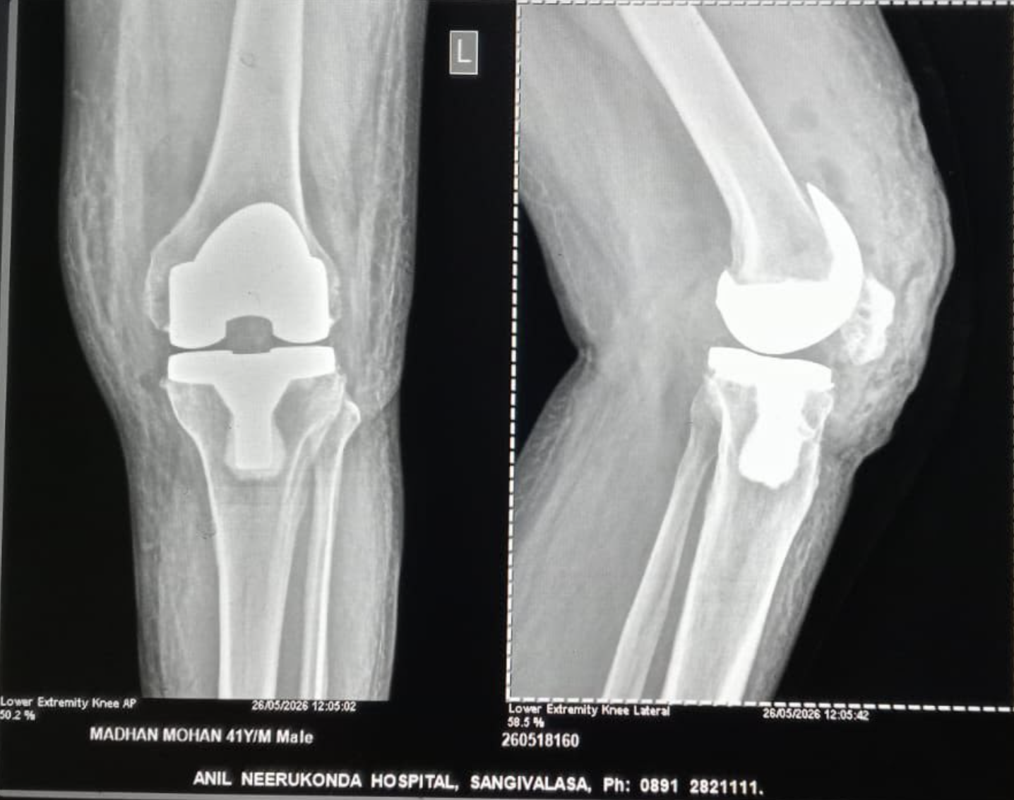 Post-operative X-ray of knee joint replacement showing implant placement