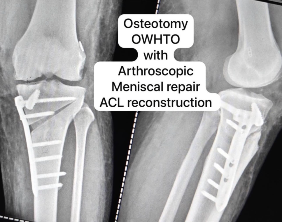 Post-operative X-ray showing successful osteotomy and ACL reconstruction
